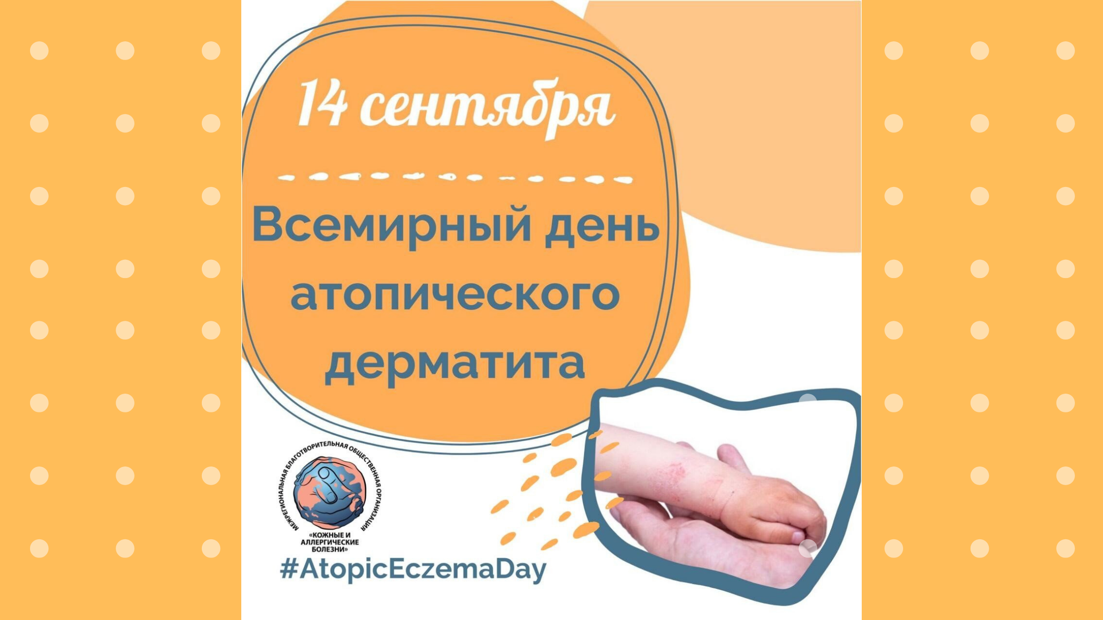 14 сентября - Всемирный день атопического дерматита.